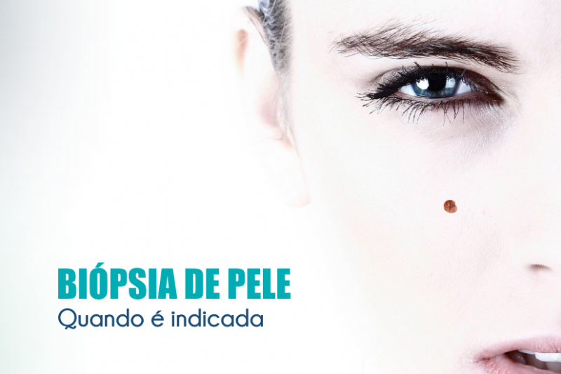 Imagem de Biópsia de Pele | Quando É Indicada?