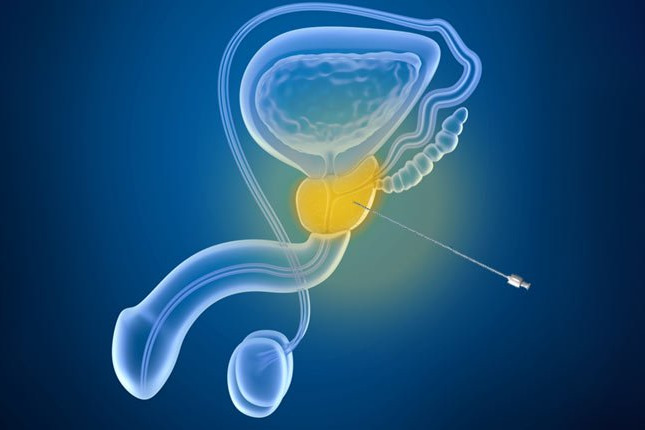Imagem de Biópsia de Próstata