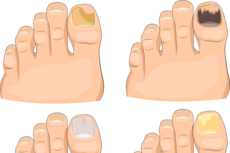 Imagem de Biópsia de Unha