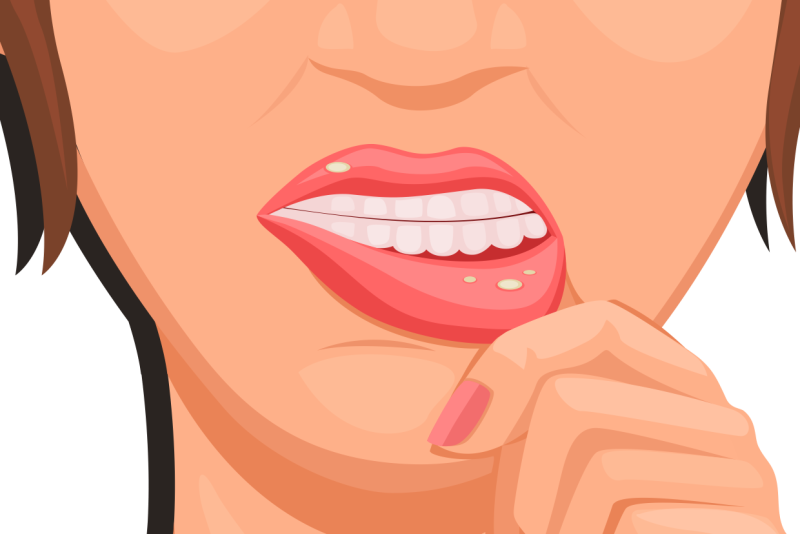 Imagem de Câncer Bucal