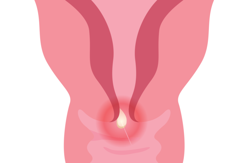 Imagem de Câncer do Colo do Útero | Faça o Papanicolau