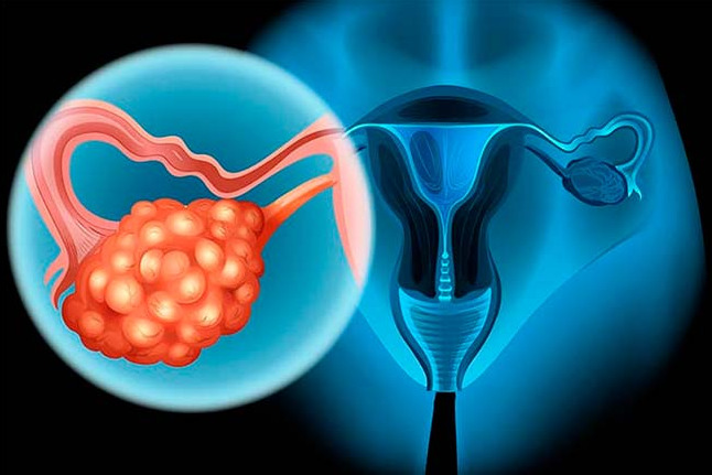 Imagem de Câncer de Ovário