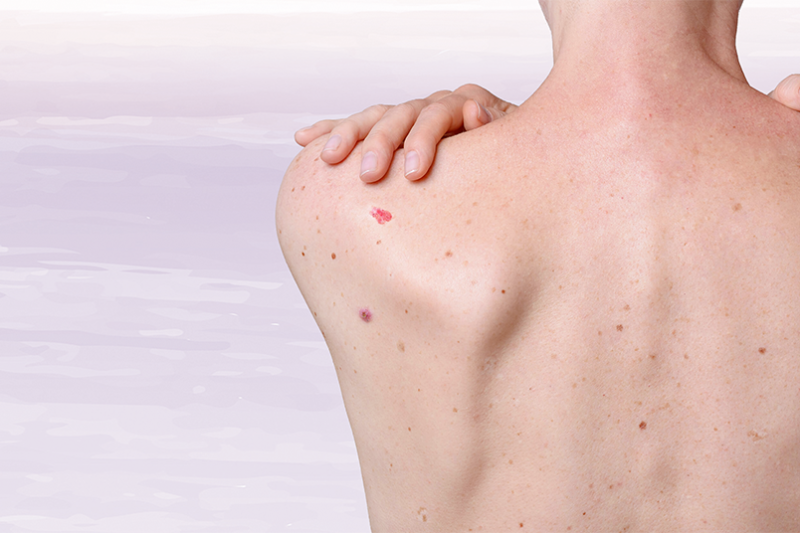 Imagem de Dezembro Laranja: Prevenção do Câncer de Pele