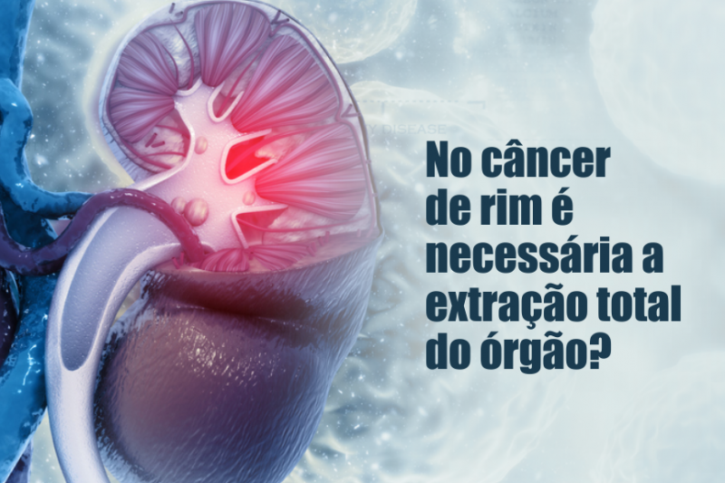 Imagem de No Câncer de Rim É Necessária a Extração Total do Órgão?