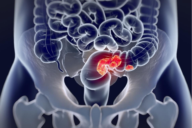 Imagem de Como Prevenir o Câncer de Intestino