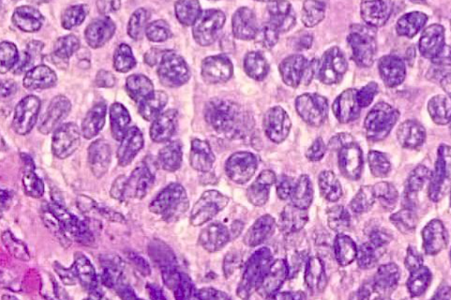 Imagem de Neoplasia Maligna Indolente 