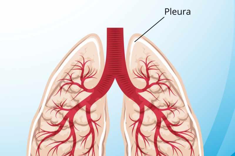 Imagem de Derrame Pleural