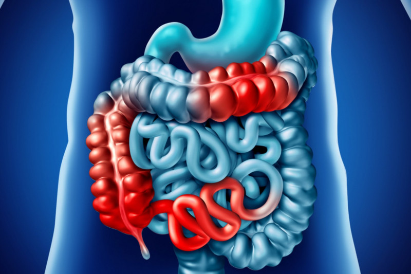 Imagem de Doença de Crohn