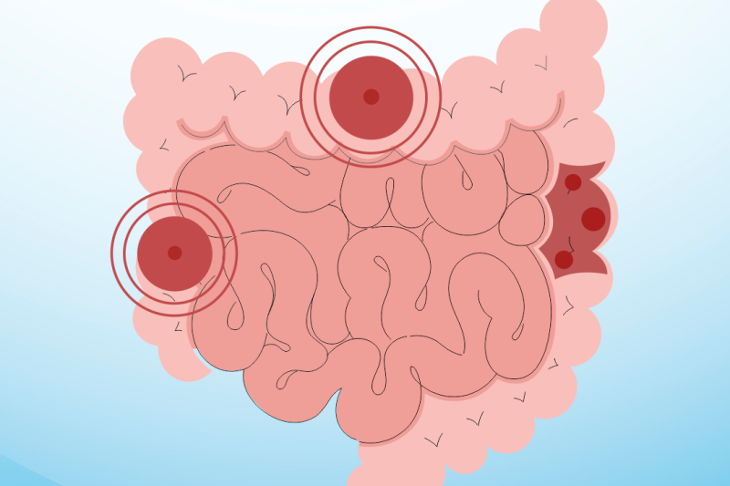 Doenças Inflamatórias Intestinais Saiba Mais Centro De Diagnóstico Santa Clara 2290