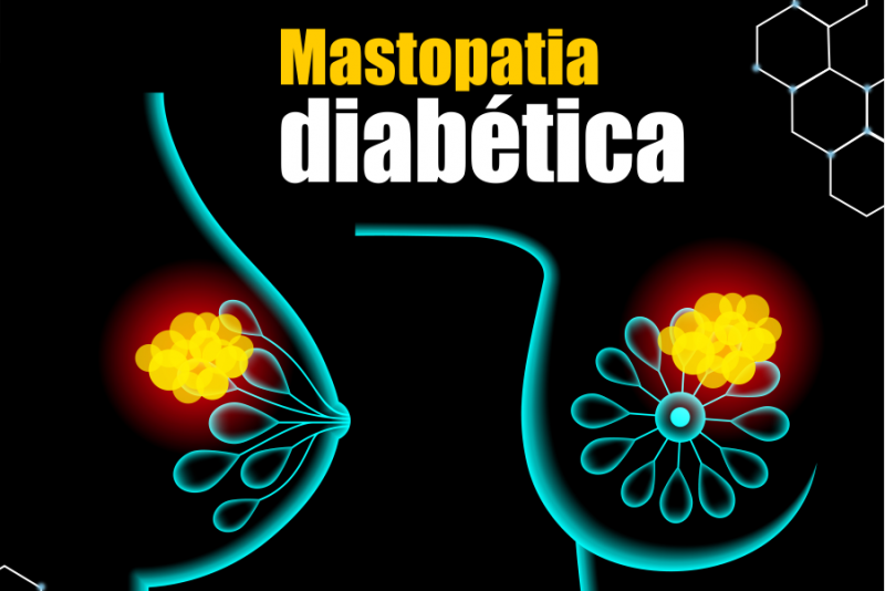 Imagem de Mastopatia Diabética