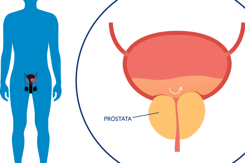 Imagem de Biópsia de Próstata | Quando é Recomendada