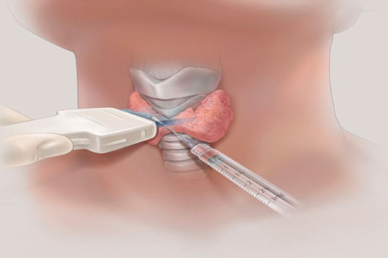 Imagem de Punção de Tireoide
