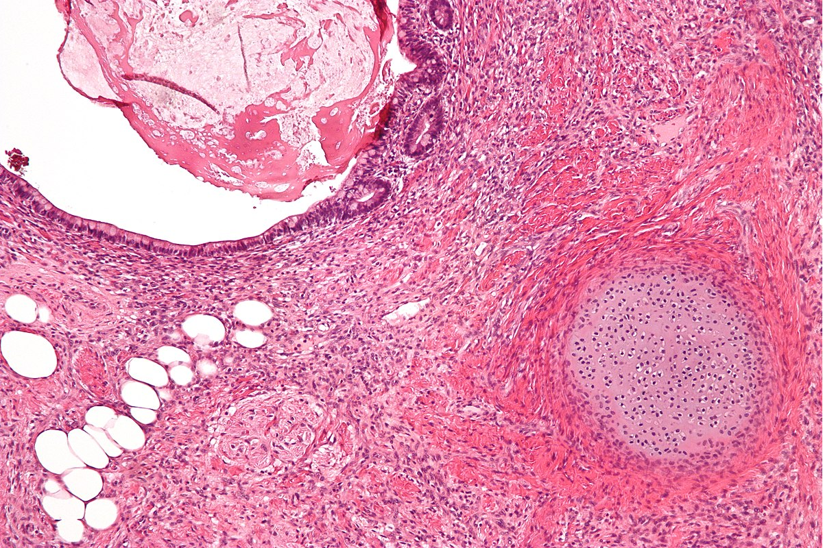 Imagem de Biópsias cirúrgicas Complexas
