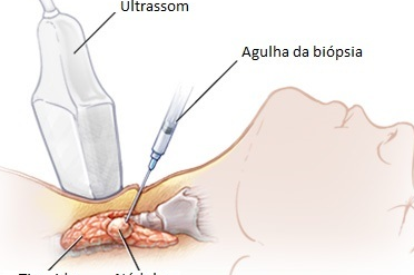 Background de Punção aspirativa por agulha fina (PAAF)